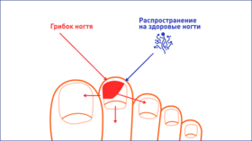 Картинка изображающая симптомы грибка ногтей